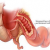 crohn.png