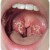 pharyngitis.jpg